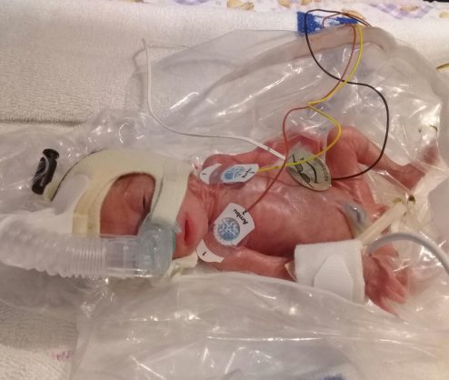 SA's smallest surviving micro-premature baby discharged ...
