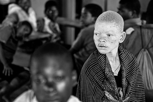 ANA file picture of a young Malawian with albinism.