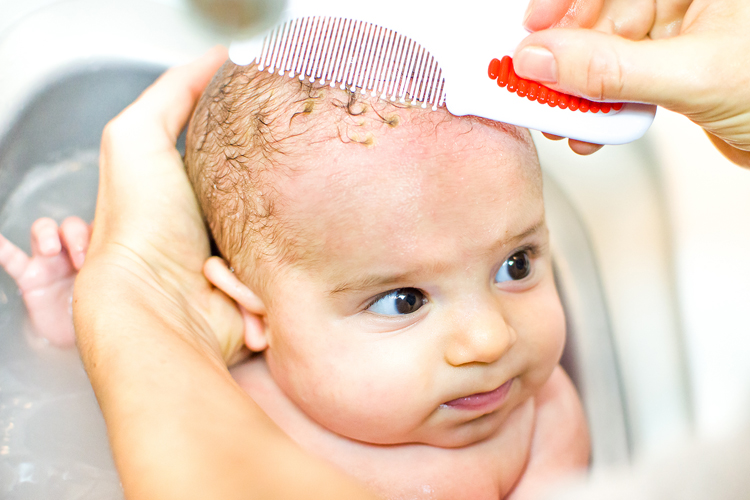 How Parents Can Get Rid Of Cradle Cap The Citizen