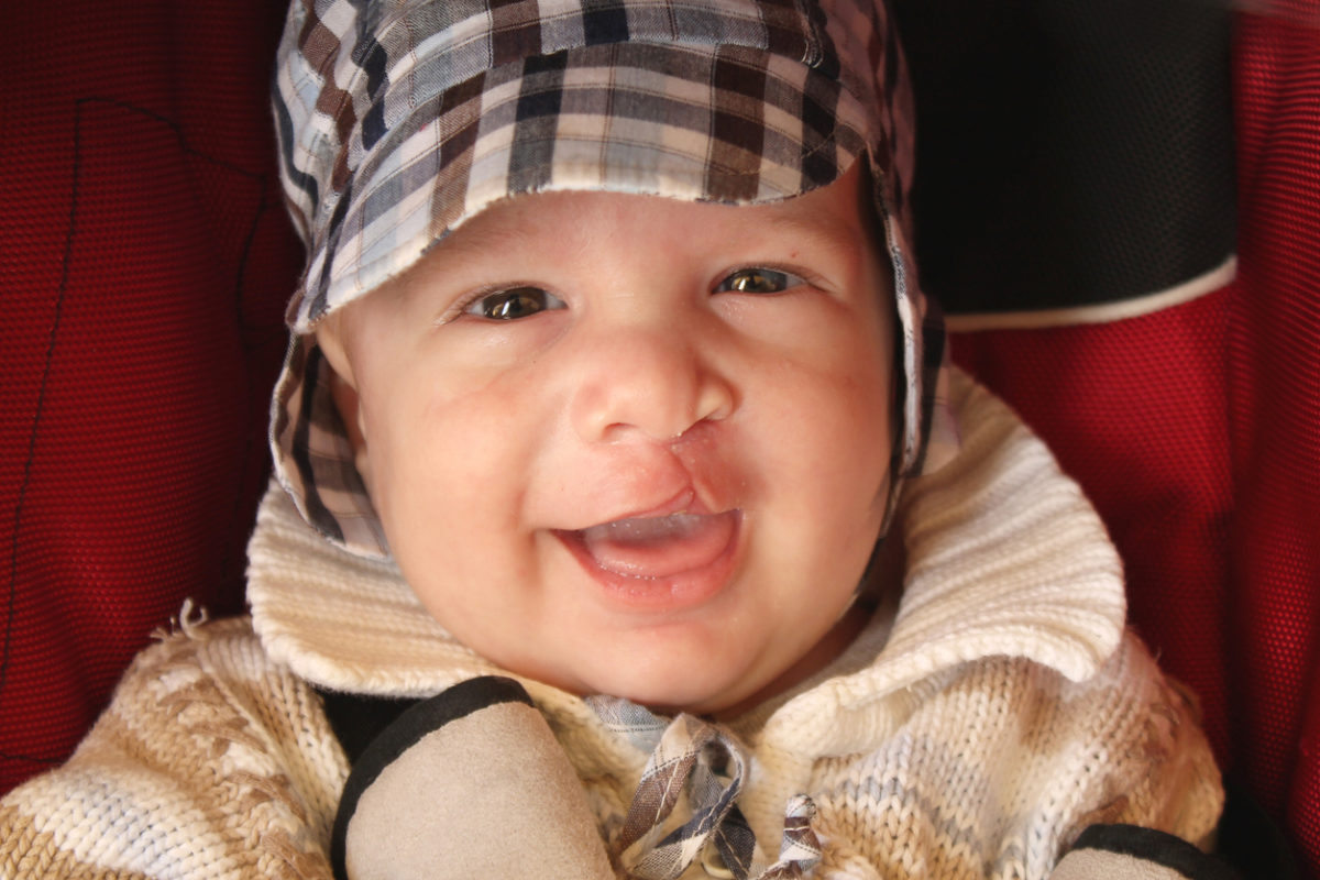 Smiling baby with a cleft lip.