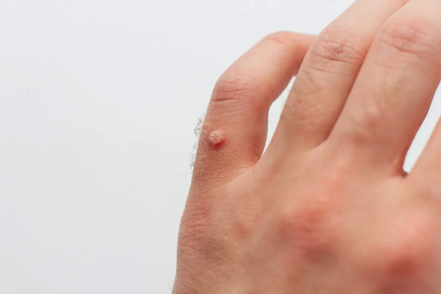 Everything you need to know about summertime warts, and how to get rid of them